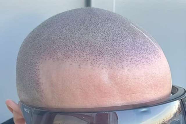 Micropigmentation