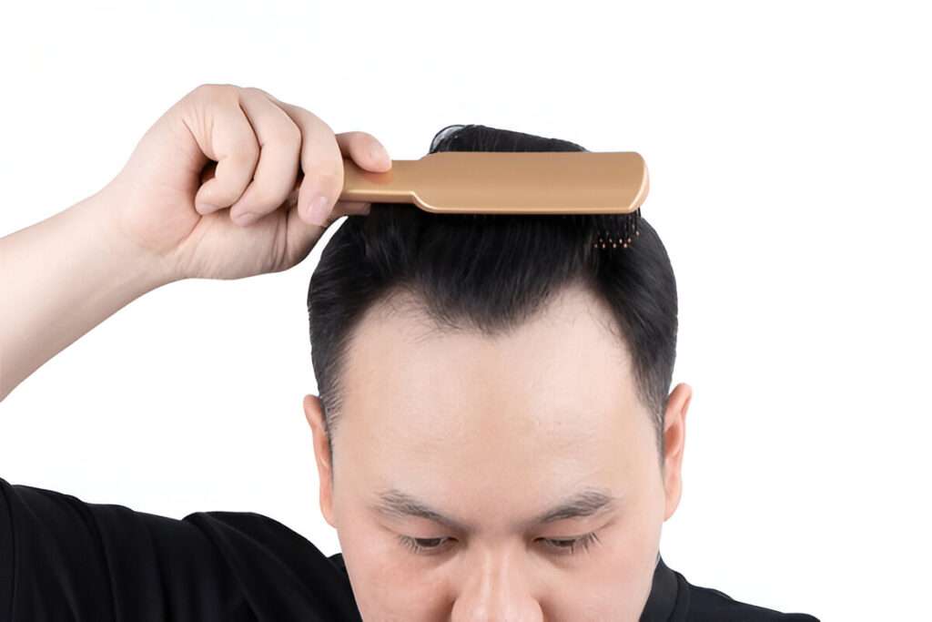 hair transplant UK