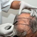hair transplant UK