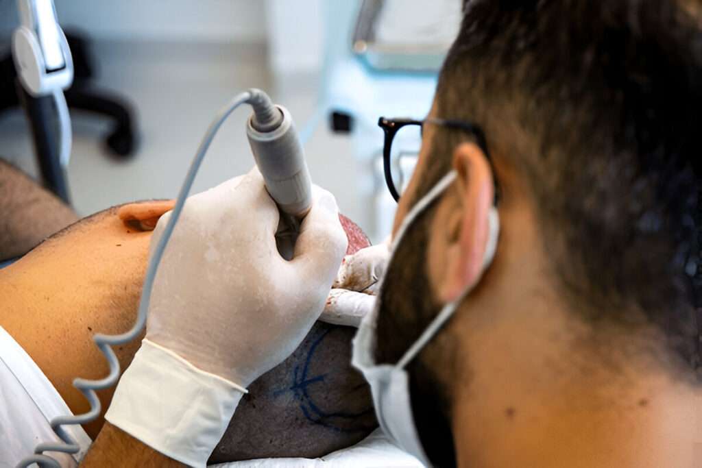 Hair Transplant