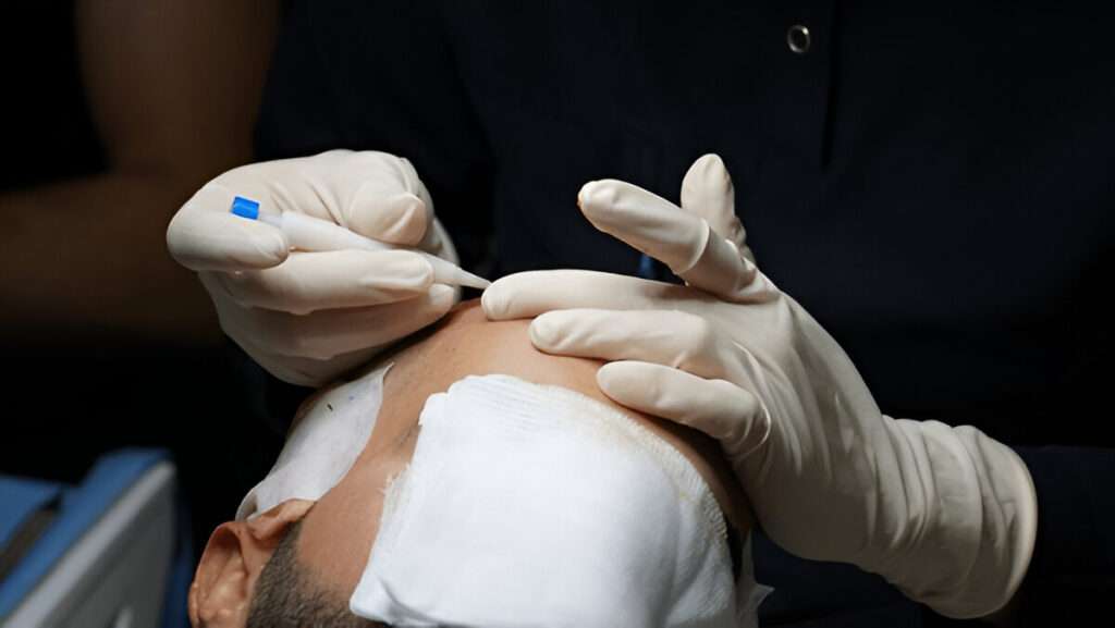 best hair transplant UK