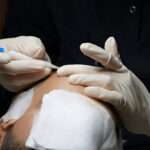 best hair transplant UK