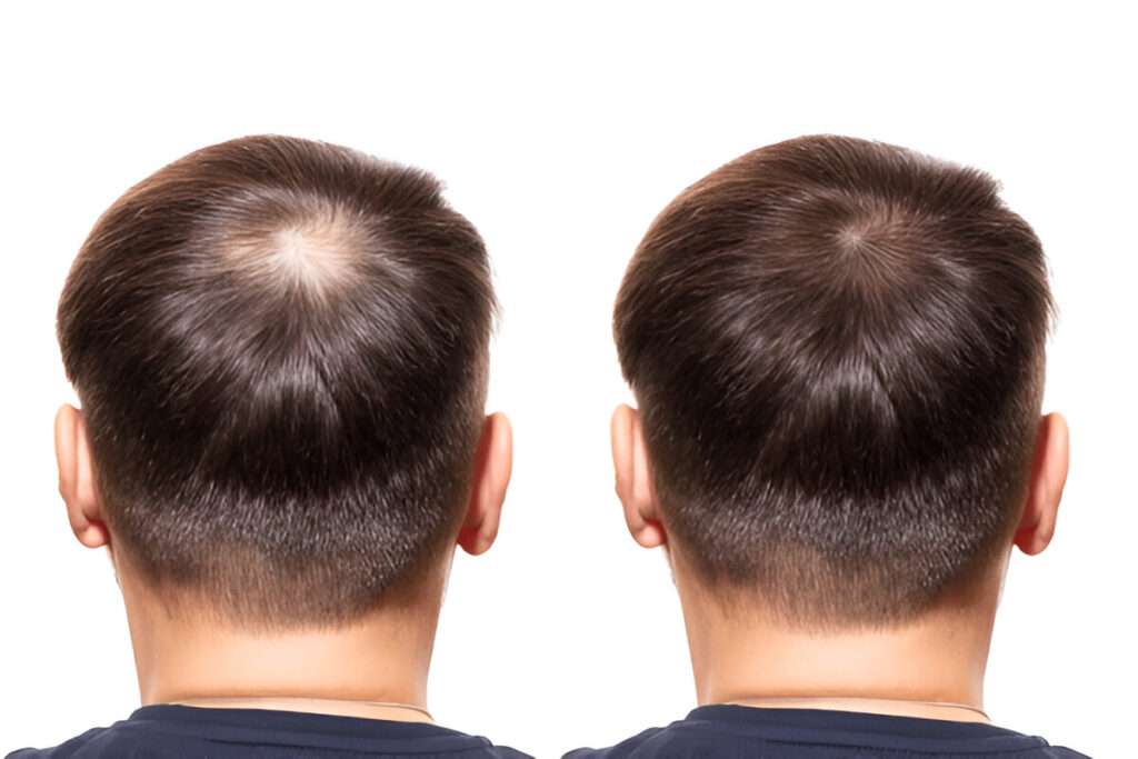 Hair Transplants