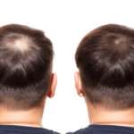 Hair Transplants