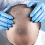 manual hair transplant London