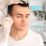 hair Transplant London