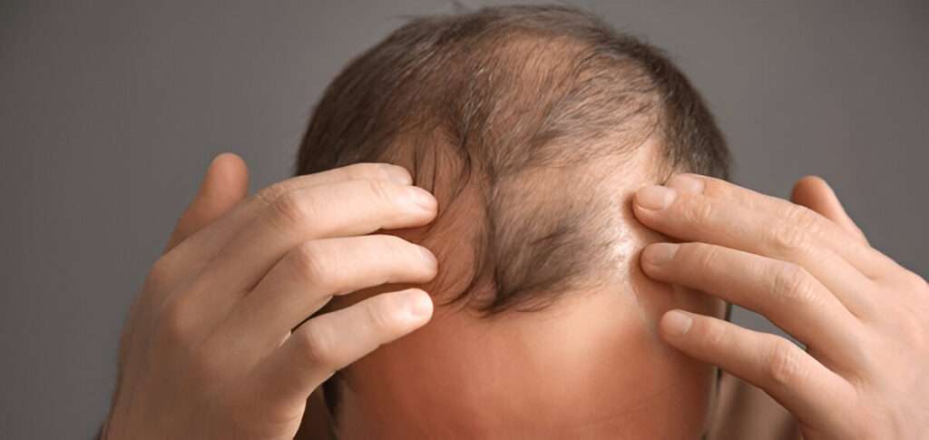 hair transplant Manchester