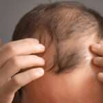 hair transplant Manchester