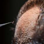 hair transplant Bristol