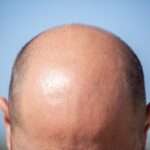 hair transplant London