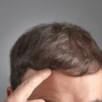 hair transplant