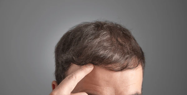 hair transplant