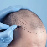hairloss treatment