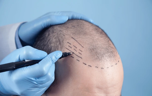 hairloss treatment