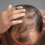 Jude Law hair transplant