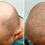 Gordon Ramsay hair transplant before and after