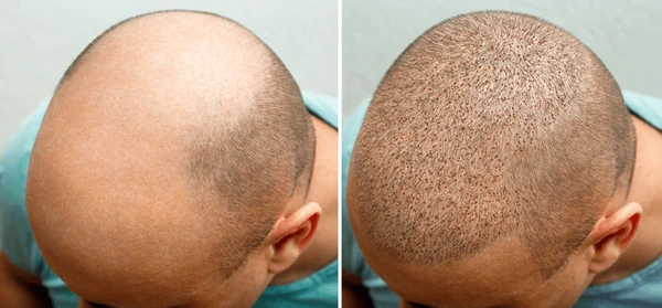 Gordon Ramsay hair transplant before and after