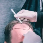 rob brydon hair transplant