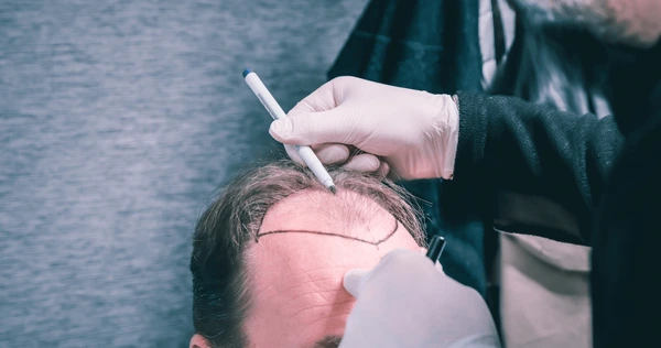 rob brydon hair transplant