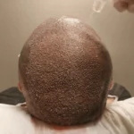 oral minoxidil UK