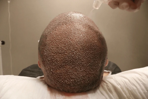 oral minoxidil UK