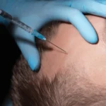 seborrhoeic Dermatitis